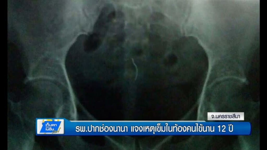 เก็บตกทั่วไทย 1-6-60 (2) รพ.ปากช่องนานาแจงเหตุเข็มในท้องคนไข้นาน12 ปี เก็บตกทั่วไทย 1-6-60 (2) รพ.ปากช่องนานาแจงเหตุเข็มในท้องคนไข้นาน12 ปี
