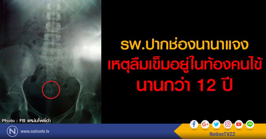 รพ.ปากช่องนานาแจง
เหตุลืมเข็มอยู่ในท้องคนไข้
นานกว่า 12 ปี รพ.ปากช่องนานาแจง
เหตุลืมเข็มอยู่ในท้องคนไข้
นานกว่า 12 ปี