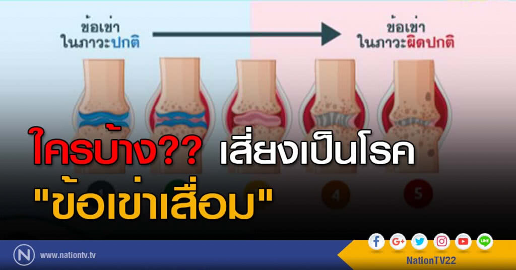 แพทย์เตือนอายุ 40 เสี่ยงข้อเข่าเสื่อม โดยเฉพาะเพศหญิง แพทย์เตือนอายุ 40 เสี่ยงข้อเข่าเสื่อม โดยเฉพาะเพศหญิง