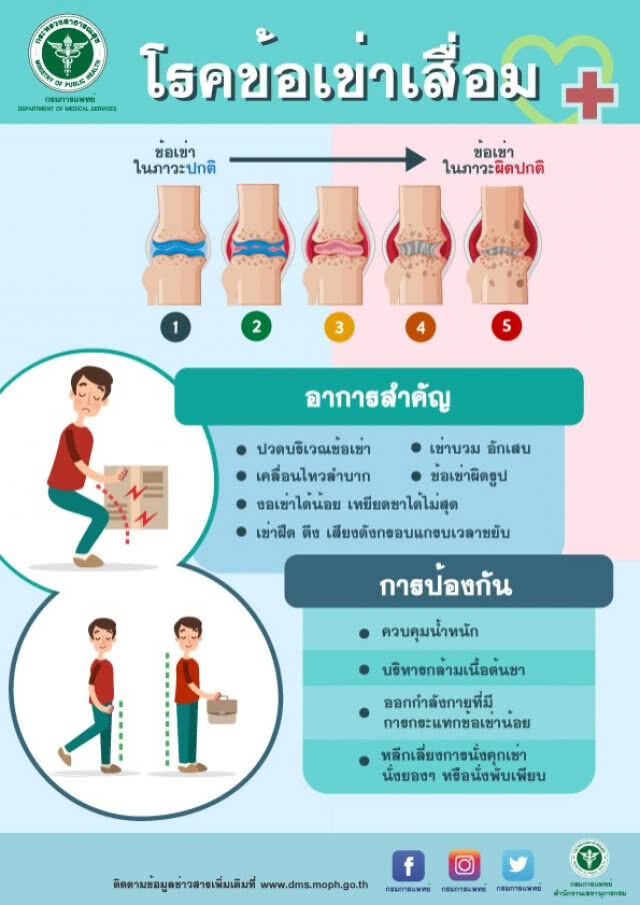 แพทย์เตือนอายุ 40 เสี่ยงข้อเข่าเสื่อม โดยเฉพาะเพศหญิง