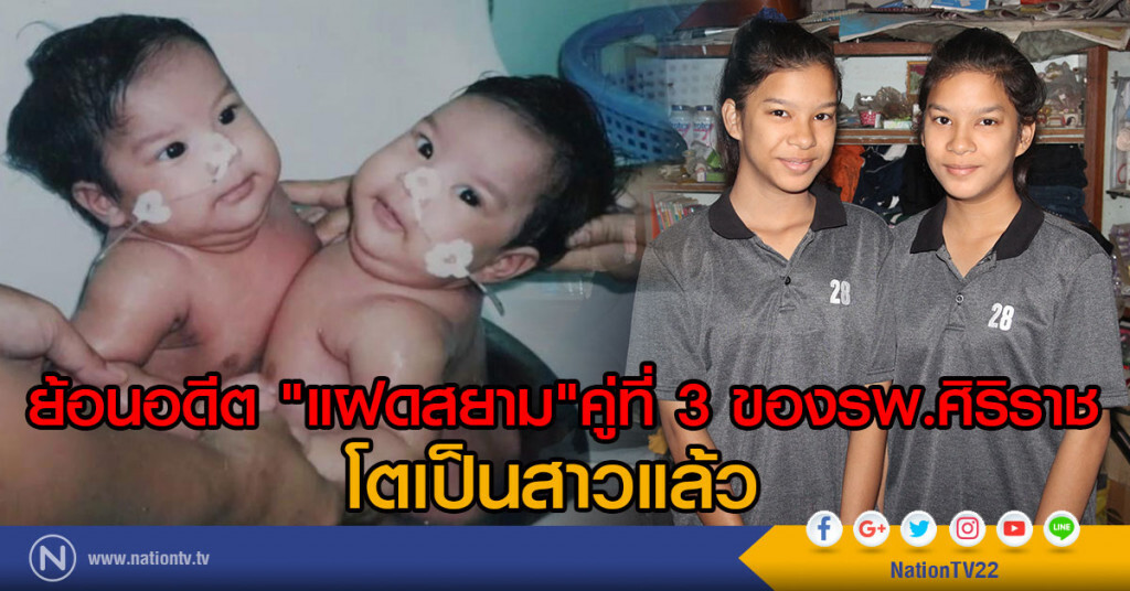 ย้อนอดีตแฝดสยามคู่ที่3ของรพ.ศิริราช โตเป็นสาวแล้ว ย้อนอดีตแฝดสยามคู่ที่3ของรพ.ศิริราช โตเป็นสาวแล้ว