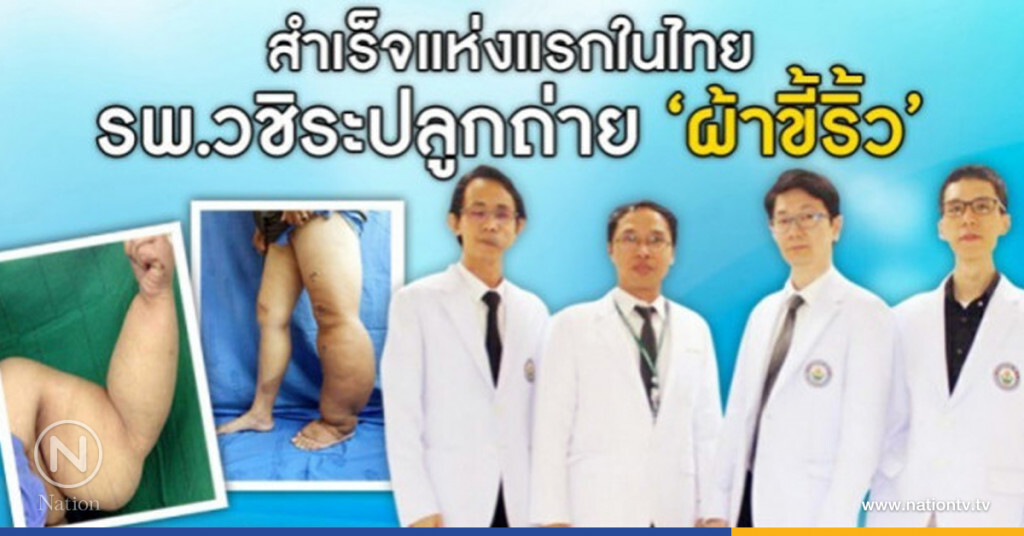 "รพ.วชิระ"ทำสำเร็จปลูกถ่ายเนื้อเยื่อน้ำเหลือง "รพ.วชิระ"ทำสำเร็จปลูกถ่ายเนื้อเยื่อน้ำเหลือง
