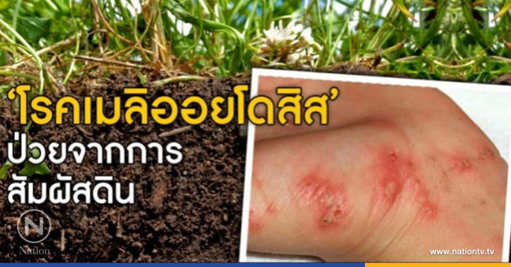 "โรคเมลิออยโดสิส" ปีนี้ดุ อีสาน-ใต้ระวัง! "โรคเมลิออยโดสิส" ปีนี้ดุ อีสาน-ใต้ระวัง!