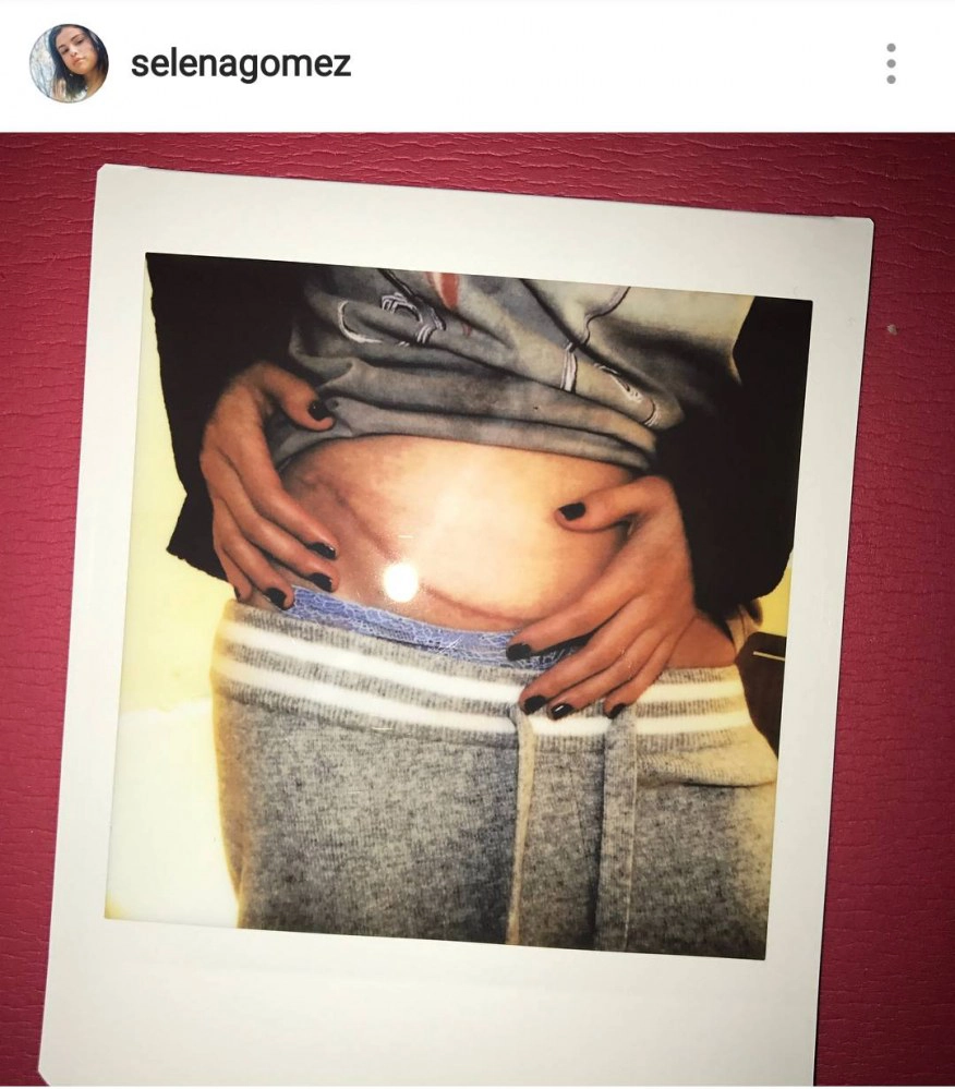 ช็อกแฟนคลับ! "เซเลน่า โกเมส" เปลี่ยนไต รักษาโรคพุ่มพวง