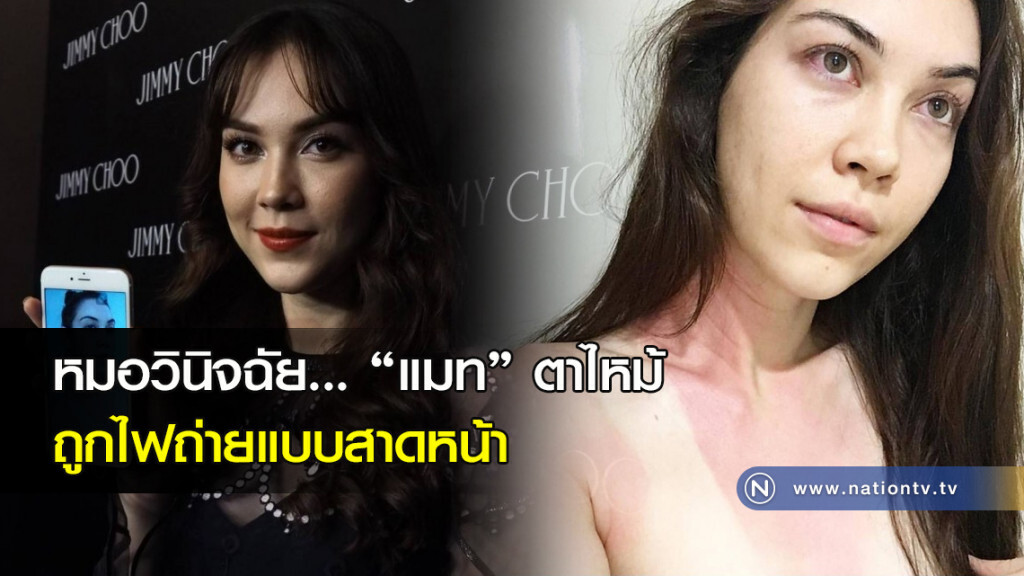 หมอวินิจฉัย... 'แมท' ตาไหม้ ถูกไฟถ่ายแบบสาดหน้า (คลิป)