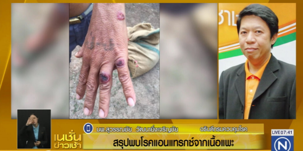 ชี้ผู้ป่วยแม่สอด ติดเชื้อแอนแทรกซ์ จากเนื้อแพะ ชี้ผู้ป่วยแม่สอด ติดเชื้อแอนแทรกซ์ จากเนื้อแพะ