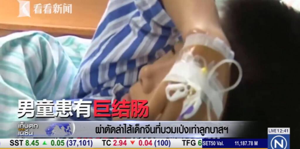 หมอจีน ผ่าตัดลำไส้เด็ก 8 ขวบ หลังมีอาการบวมเบ่งเท่าลูกบาส หมอจีน ผ่าตัดลำไส้เด็ก 8 ขวบ หลังมีอาการบวมเบ่งเท่าลูกบาส