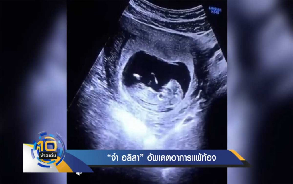"จ๋า อลิสา" อัพเดตอาการแพ้ท้องเผยลูกในครรภ์แข็งแรงดี "จ๋า อลิสา" อัพเดตอาการแพ้ท้องเผยลูกในครรภ์แข็งแรงดี