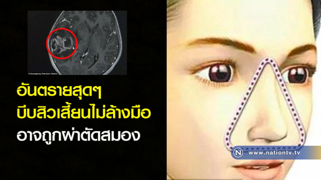 อันตรายสุดๆ บีบสิวเสี้ยนไม่ล้างมือ อาจถูกผ่าตัดสมอง อันตรายสุดๆ บีบสิวเสี้ยนไม่ล้างมือ อาจถูกผ่าตัดสมอง
