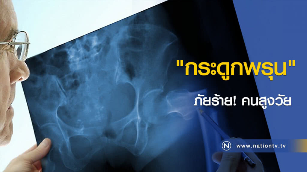 "กระดูกพรุน" ภัยร้าย! คนสูงวัย "กระดูกพรุน" ภัยร้าย! คนสูงวัย