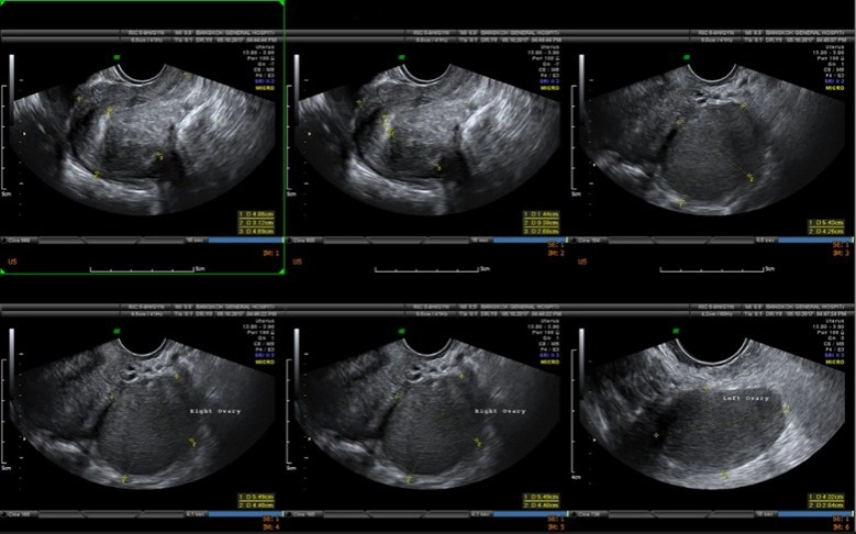 ผู้หญิงอย่าชะล่าใจ!! 3 โรคภายในรอเวลาระเบิด
