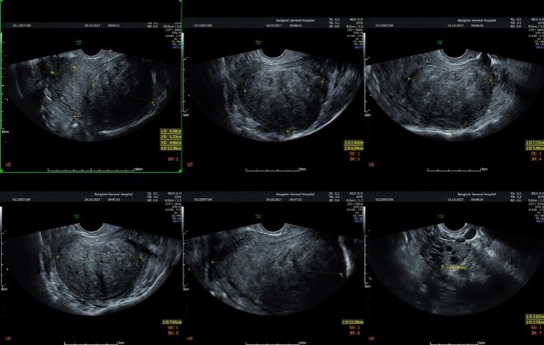 ผู้หญิงอย่าชะล่าใจ!! 3 โรคภายในรอเวลาระเบิด