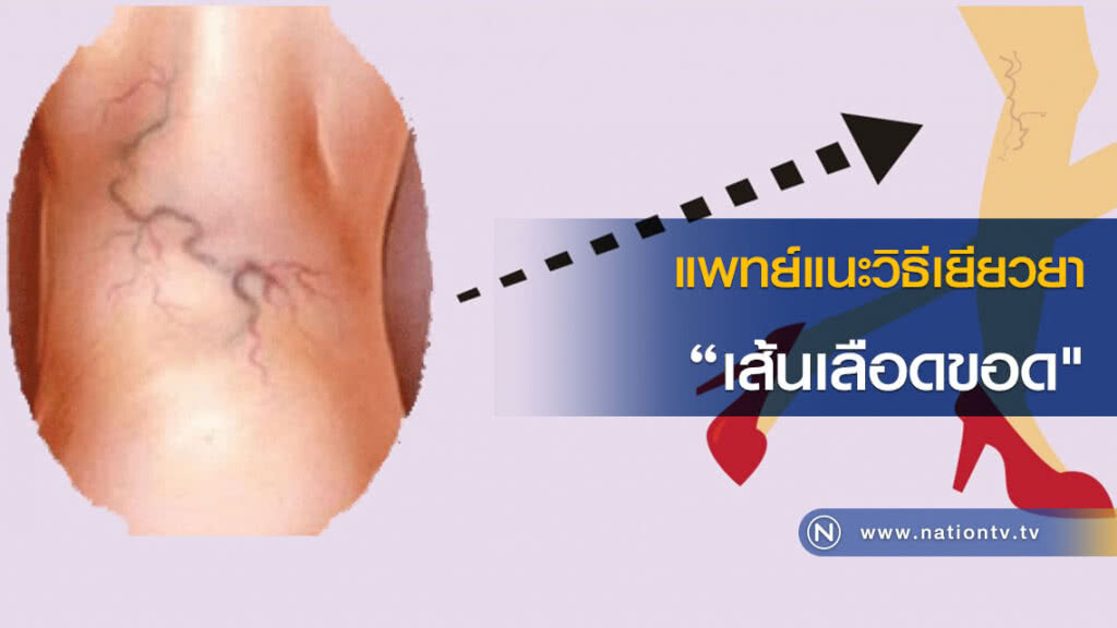 แพทย์แนะวิธีเยียวยา "เส้นเลือดขอด" แพทย์แนะวิธีเยียวยา "เส้นเลือดขอด"