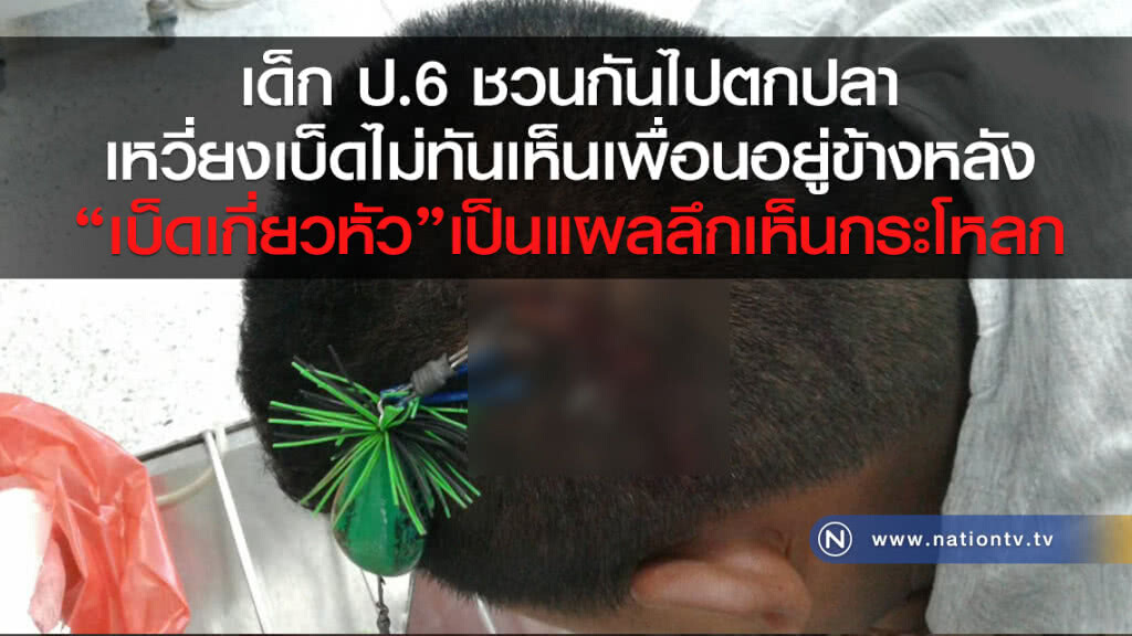 เตือนภัย! เบ็ดฝรั่งเกี่ยวศีรษะเด็กสุดหวาดเสียว แผลลึกเห็นกระโหลกศีรษะ หวิดตาบอด