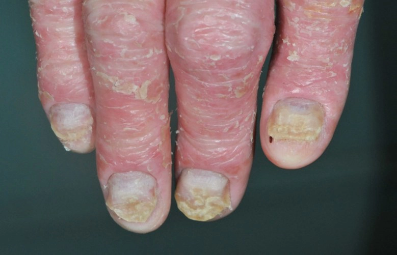 4 เคล็ดลับดูแลผู้ป่วย "โรคสะเก็ดเงิน"