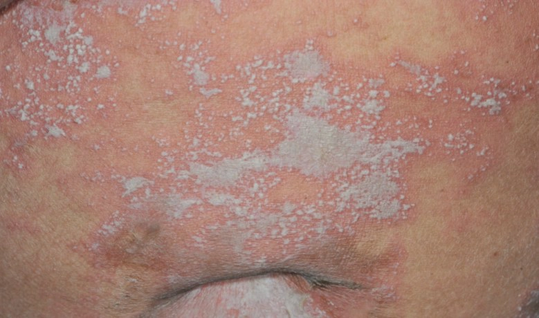 4 เคล็ดลับดูแลผู้ป่วย "โรคสะเก็ดเงิน"