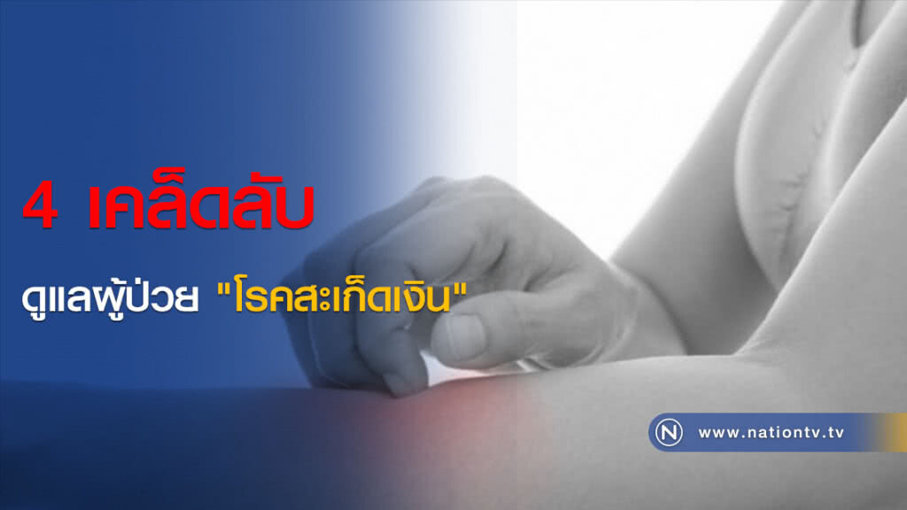 4 เคล็ดลับดูแลผู้ป่วย "โรคสะเก็ดเงิน"