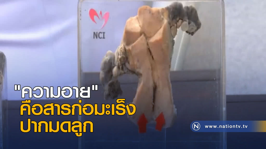 "ความอาย" คือสารก่อมะเร็งปากมดลูก