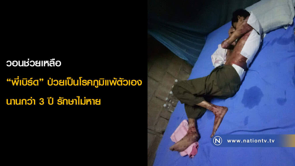 วอนช่วยเหลือ "พี่เบิร์ด" ป่วยเป็นโรคภูมิแพ้ตัวเองนานกว่า 3 ปี รักษาไม่หาย วอนช่วยเหลือ "พี่เบิร์ด" ป่วยเป็นโรคภูมิแพ้ตัวเองนานกว่า 3 ปี รักษาไม่หาย