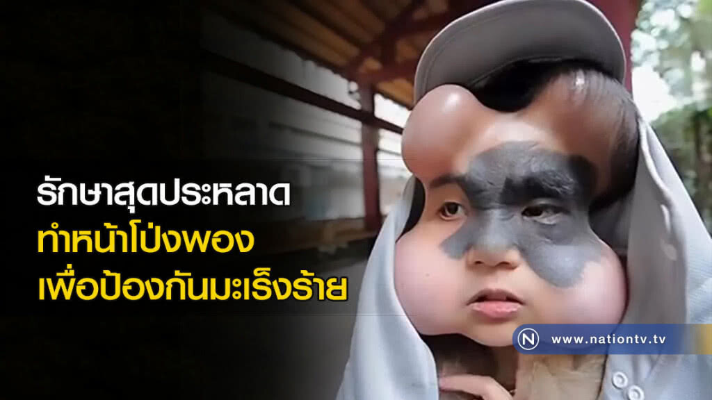 รักษาสุดประหลาด ทำหน้าโป่งพอง เพื่อป้องกันมะเร็งร้าย