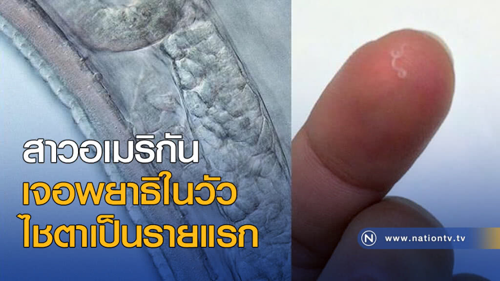 สาวอเมริกันเจอพยาธิในวัวไชตาเป็นรายแรก สาวอเมริกันเจอพยาธิในวัวไชตาเป็นรายแรก
