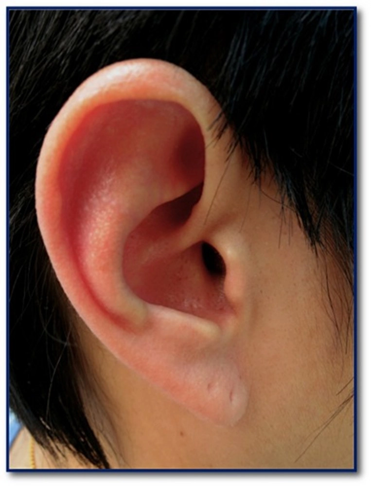 โรคหูติดเชื้อ...ร้ายแรงกว่าที่คิด