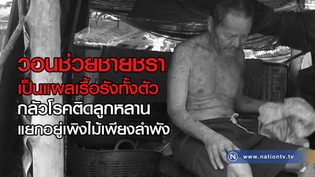 วอนช่วยชายชรา
เป็นแผลเรื้อรังทั้งตัว
กลัวโรคติดลูกหลาน
แยกอยู่เพิงไม้เพียงลำพัง วอนช่วยชายชรา
เป็นแผลเรื้อรังทั้งตัว
กลัวโรคติดลูกหลาน
แยกอยู่เพิงไม้เพียงลำพัง