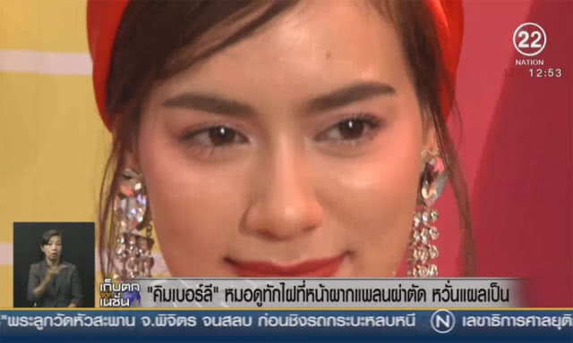 "คิมเบอร์ลี"หมอดูทักไฝที่หน้าผาก เจ้าตัวแพลนผ่าตัด หวั่นแผลเป็น