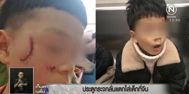 พ่อแม่ปล่อยลูกเล่นตามลำพัง โดนกระจกแตกใส่ หน้าเสียโฉม