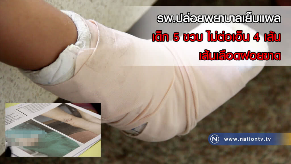 โวย!! รพ.ไร้แพทย์ปล่อยพยาบาลเย็บแผลเด็ก 5 ขวบ ไม่ต่อเอ็น 4 เส้น เส้นเลือดฝอยขาด(คลิป)