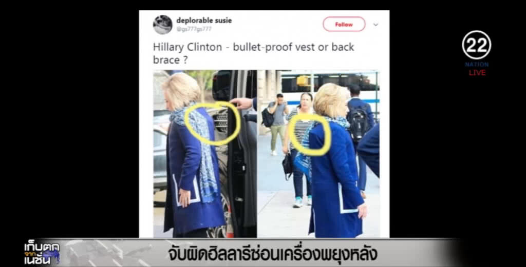 "ฮิลลารี" ถูกชาวโซเชียล จับผิดสวมเครื่องช่วยพยุงหลัง "ฮิลลารี" ถูกชาวโซเชียล จับผิดสวมเครื่องช่วยพยุงหลัง