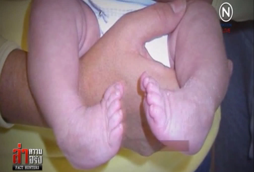 "เท้าปุก-กระดูกคด" โรคฮิตเด็กไทยยุคใหม่