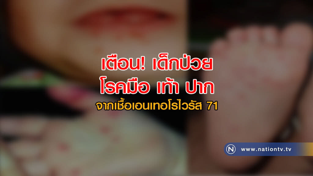 สธ. เตือน ระวังเด็กป่วยโรคมือ เท้า ปาก จากเชื้อเอนเทอโรไวรัส 71 สธ. เตือน ระวังเด็กป่วยโรคมือ เท้า ปาก จากเชื้อเอนเทอโรไวรัส 71