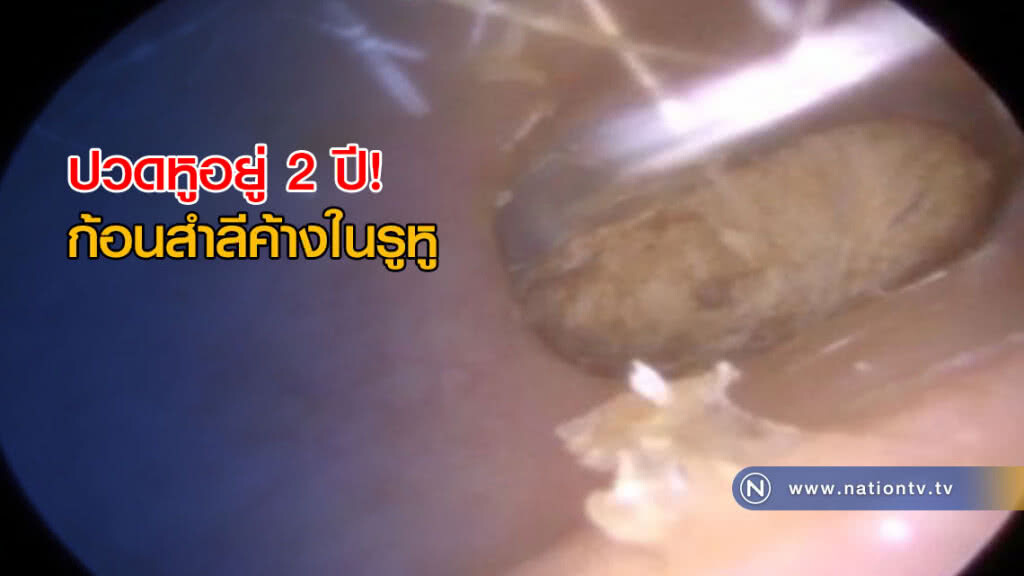 ปวดหูอยู่ 2 ปี! ก่อนรู้ตัวว่าก้อนสำลีค้างในรูหู (มีคลิป) ปวดหูอยู่ 2 ปี! ก่อนรู้ตัวว่าก้อนสำลีค้างในรูหู (มีคลิป)