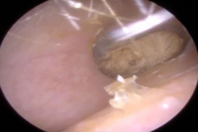 ปวดหูอยู่ 2 ปี! ก่อนรู้ตัวว่าก้อนสำลีค้างในรูหู (มีคลิป)