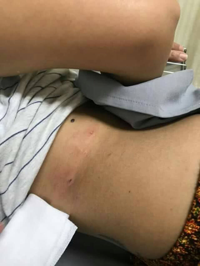 "สุนารี" โดนสุนัขกัดเจ็บหนัก นำส่งรพ.