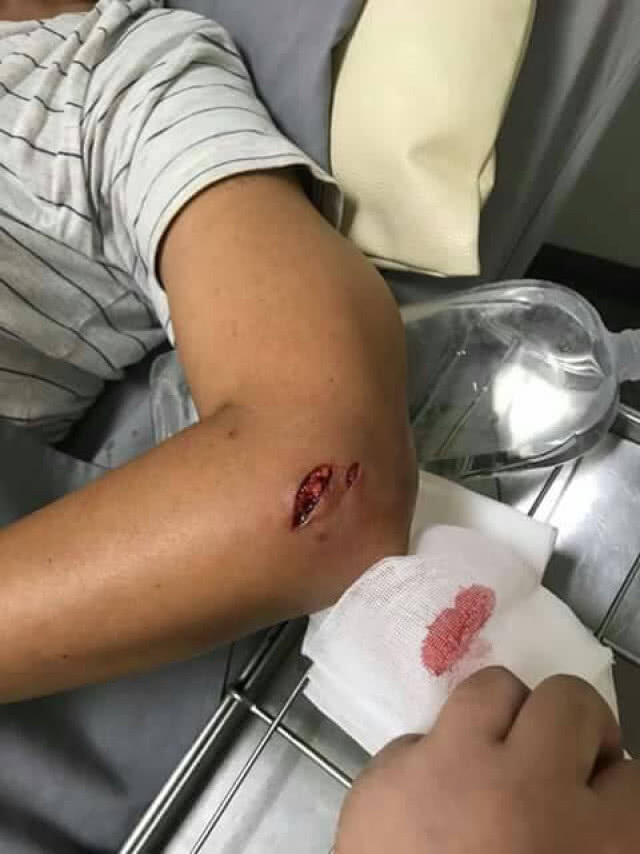 "สุนารี" โดนสุนัขกัดเจ็บหนัก นำส่งรพ.