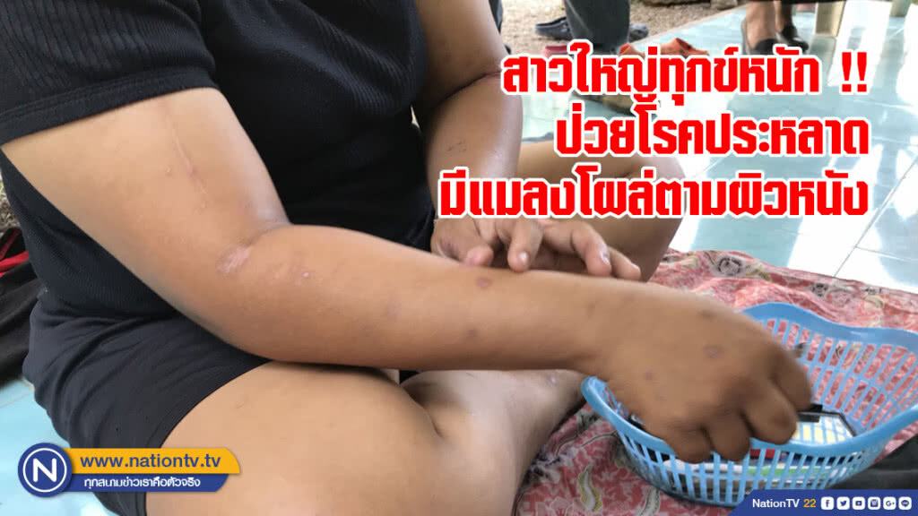 สาวใหญ่ทุกข์หนัก !! ป่วยโรคประหลาดมีแมลงโผล่ตามผิวหนัง วอนแพทย์ช่วยตรวจสอบ