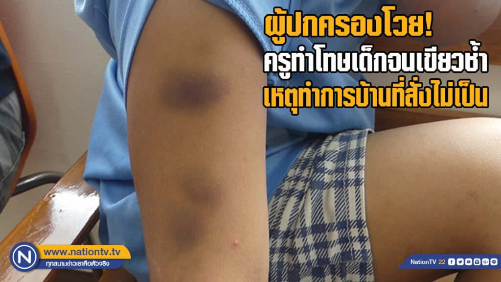 ผู้ปกครองโวย ครูทำโทษเด็กจนเขียวช้ำ เหตุทำการบ้านที่สั่งไม่เป็น