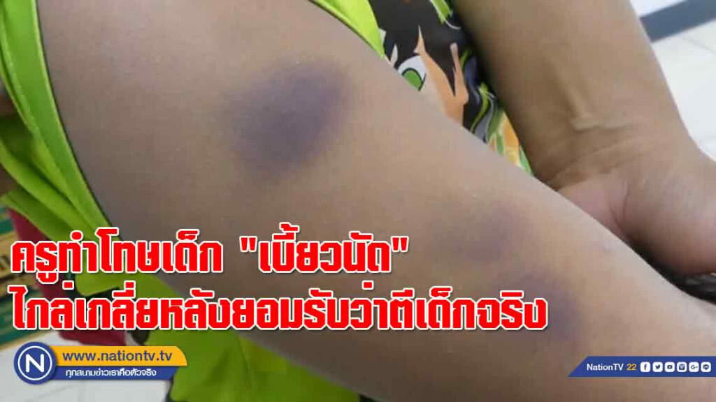 ครูทำโทษเด็ก "เบี้ยวนัด" ไกล่เกลี่ยหลังยอมรับว่าตีเด็กจริง