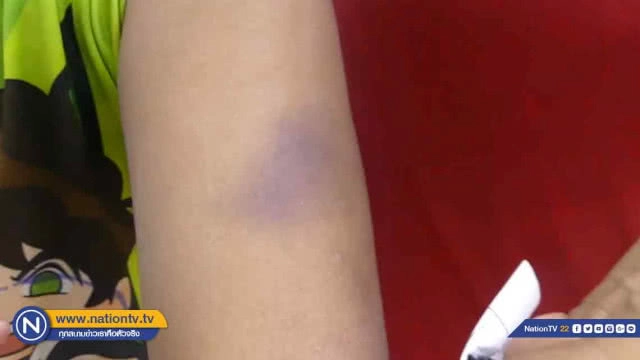 ครูทำโทษเด็ก "เบี้ยวนัด" ไกล่เกลี่ยหลังยอมรับว่าตีเด็กจริง