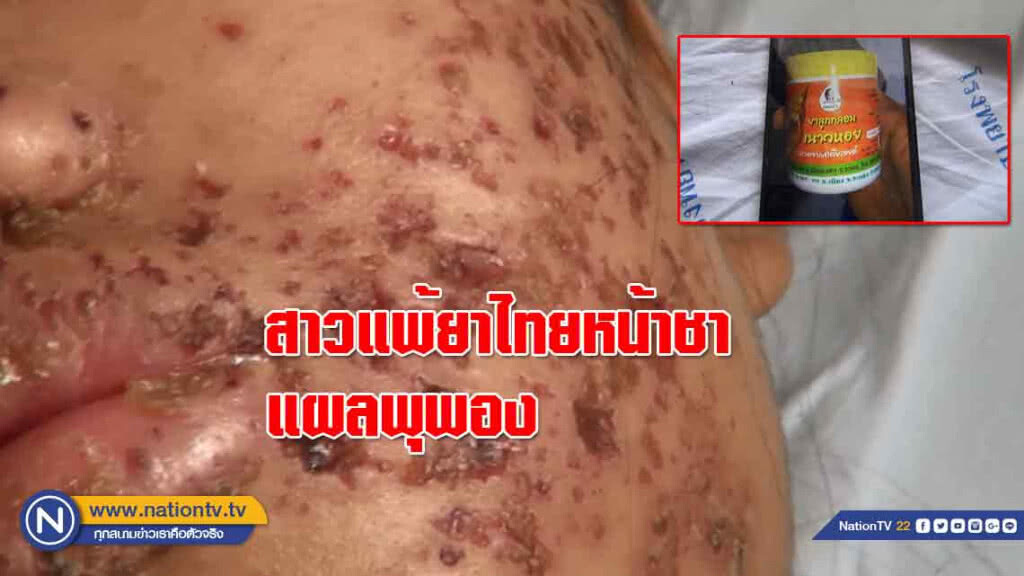 สาวเกิดแผลพุพองที่ใบหน้า แถมชาไม่มีความรู้สึก คาดเกิดจากยาแผนโบราณ