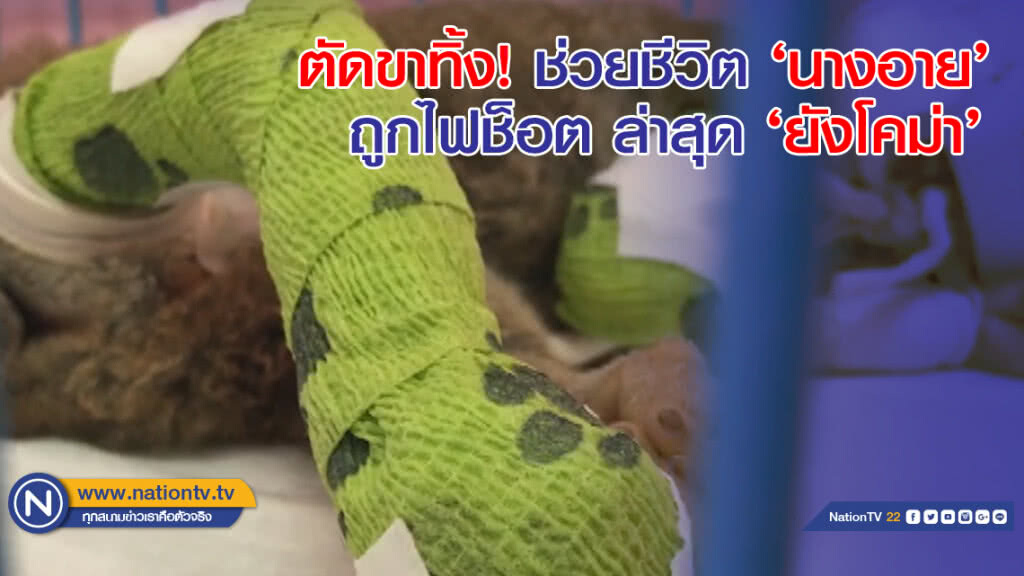 'ตัดขาทิ้ง' ช่วยชีวิตนางอาย ถูกไฟช็อต ล่าสุด 'ยังโคม่า' 'ตัดขาทิ้ง' ช่วยชีวิตนางอาย ถูกไฟช็อต ล่าสุด 'ยังโคม่า'