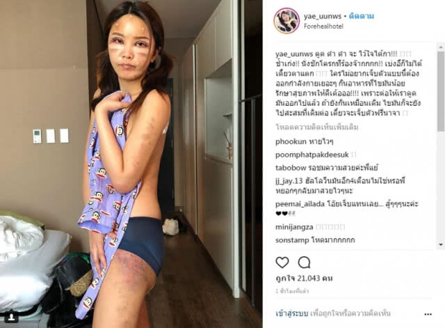 เจ้าแม่ศัลยกรรม "หญิงแย้"  โพสต์โชว์หน้าสด-บวม หลังผ่าตัดกว่า 7 ชั่วโมง!