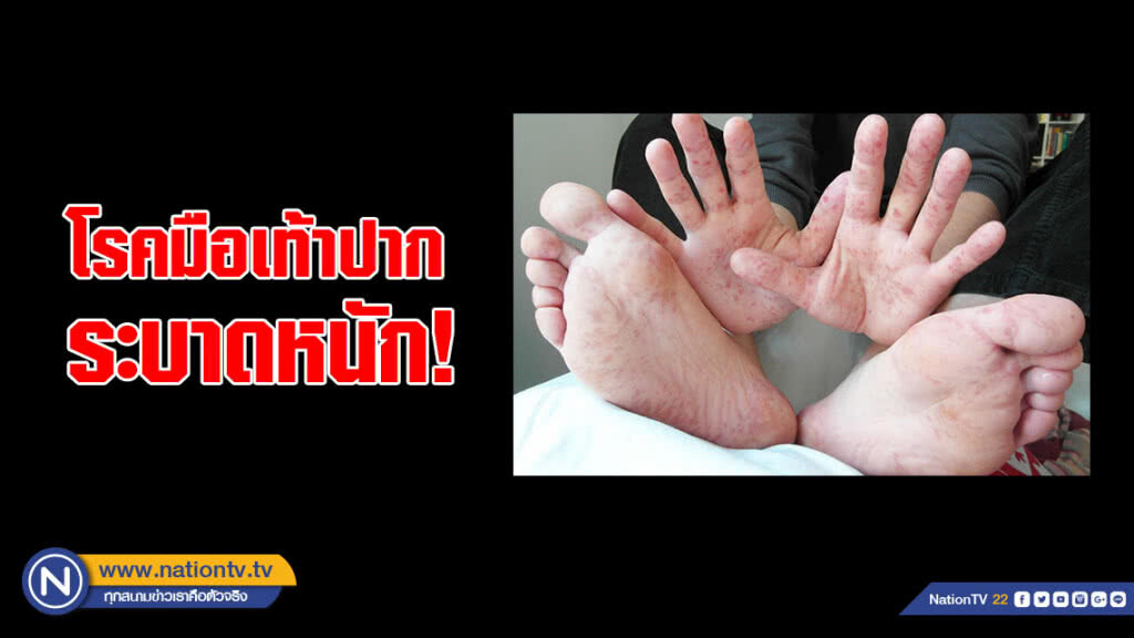 โรคมือเท้าปากระบาดหนัก!!! ระนองเด็กป่วย 78 ราย