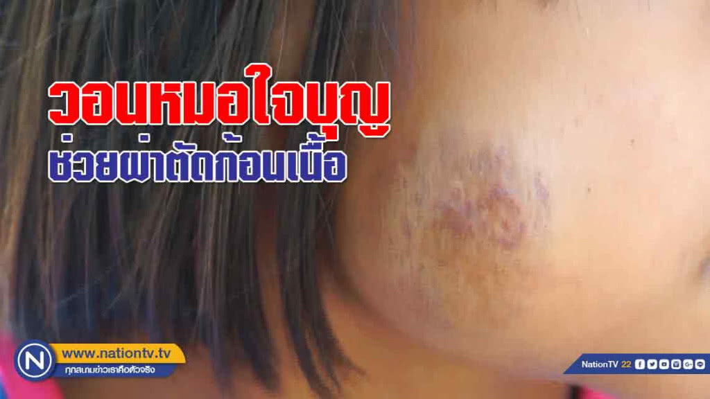 'วอนหมอใจบุญ' ช่วยผ่าตัดก้อนเนื้อบนใบหน้า 'เด็กหญิง 5 ขวบ'
