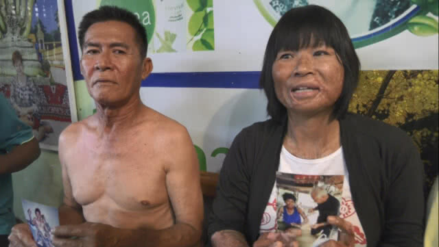 พบครีมสูตรยาจีนของอาม่า รักษาแผลไฟไหม้ แก๊สระเบิดหายขาด