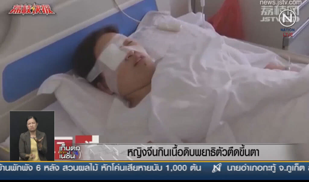 (คลิปข่าว) หญิงจีนกินเนื้่อดิบ พยาธิตัวตืดขึ้นตา (คลิปข่าว) หญิงจีนกินเนื้่อดิบ พยาธิตัวตืดขึ้นตา