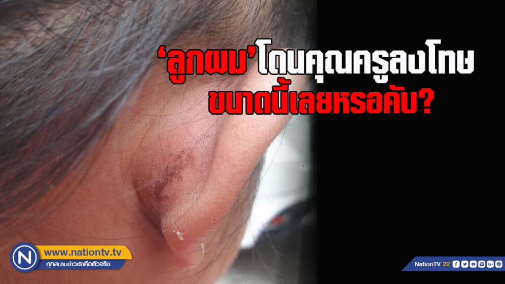 พ่อโพสเฟสบุ๊ก  "ลูกผมโดนลงโทษขนาดนี้เลยหรอครับ" หลังลูกโดนครูบิดหูจนห้อเลือดและช้ำ