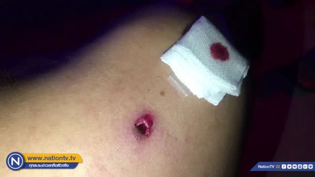 หนุ่มโรงงานเฉียดตาย !! ถูกกระสุนปริศนาเข้าไหล่ขวาระหว่างชมพลุวันแม่